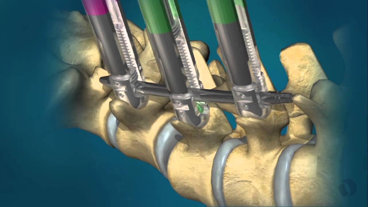 Is Minimally Invasive Spinal Fusion Surgery the Best Option for Long Term Spine Stability