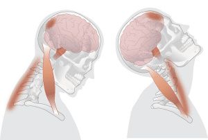 How Is Cervical Instability Diagnosed?
