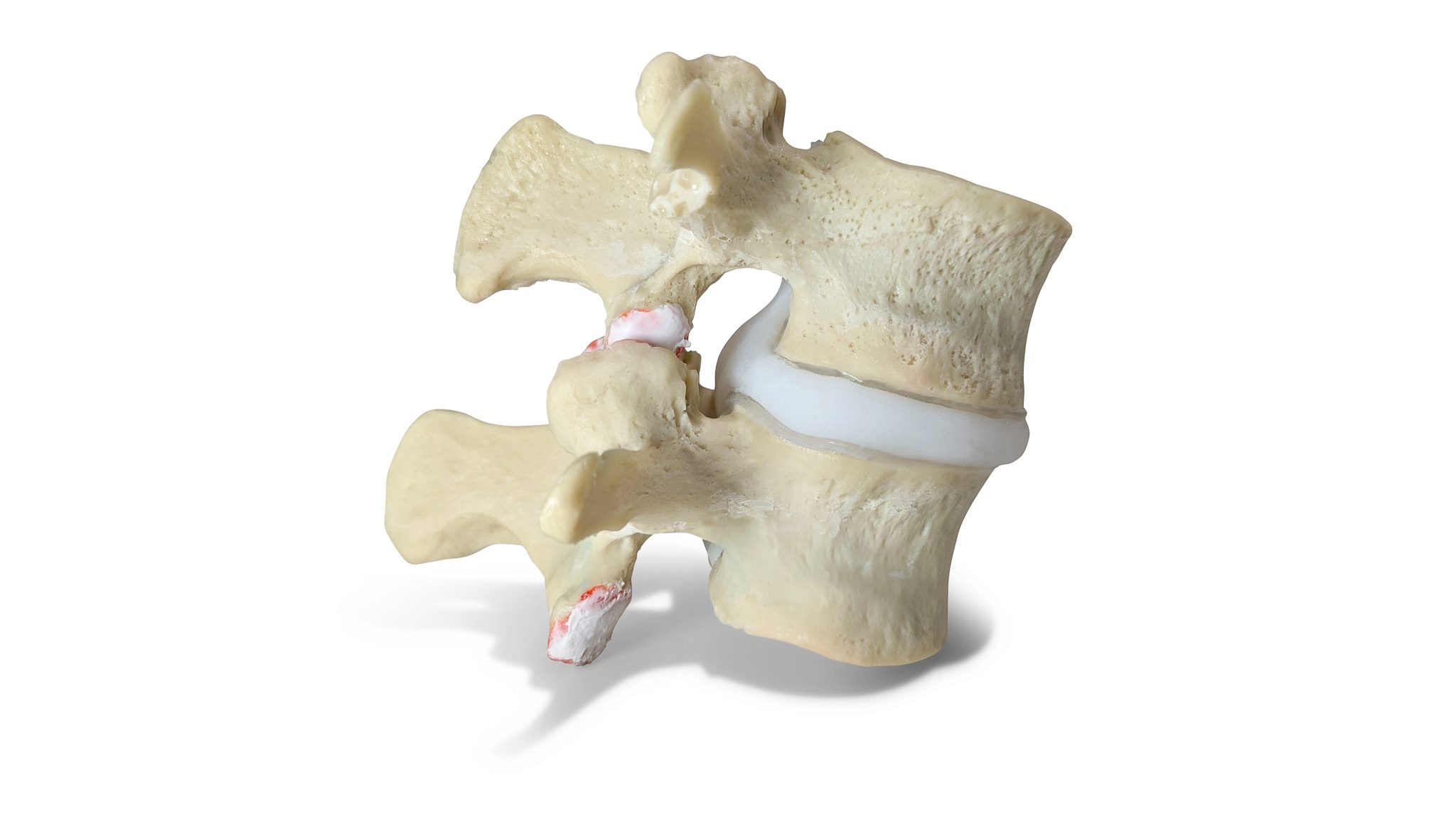 Understanding Spondylolisthesis and How Mr. Irfan Malik Can Help